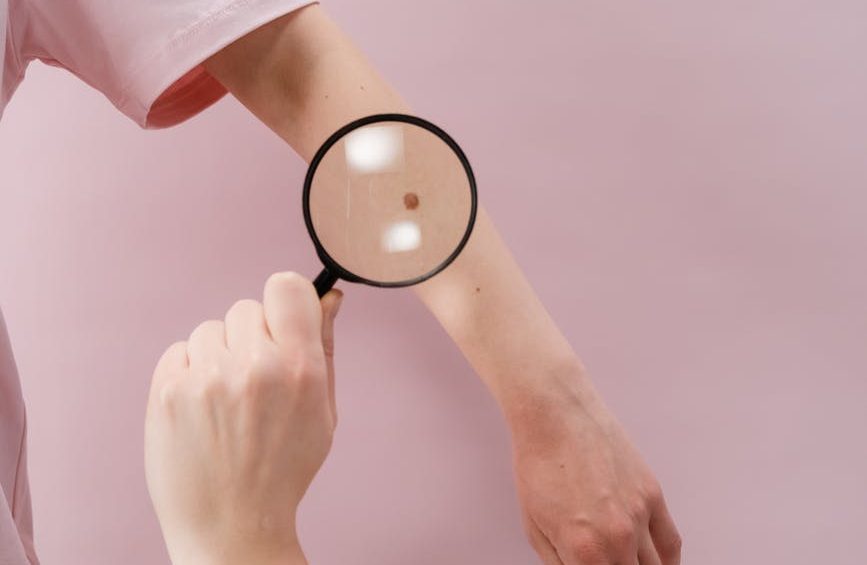 this is a picture of a skin mole or nevus which is an example of a benign tumor. This image is used in an article by Dr Suraj Manjunath on why and when benign tumors need to be treated